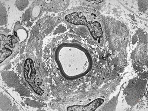 F,23y. | - n.suralis- hypertrophic demyelinizing neuropathy (onion bulbs) F,23y. | - n.suralis- hypertrophic demyelinizing neuropathy (onion bulbs)